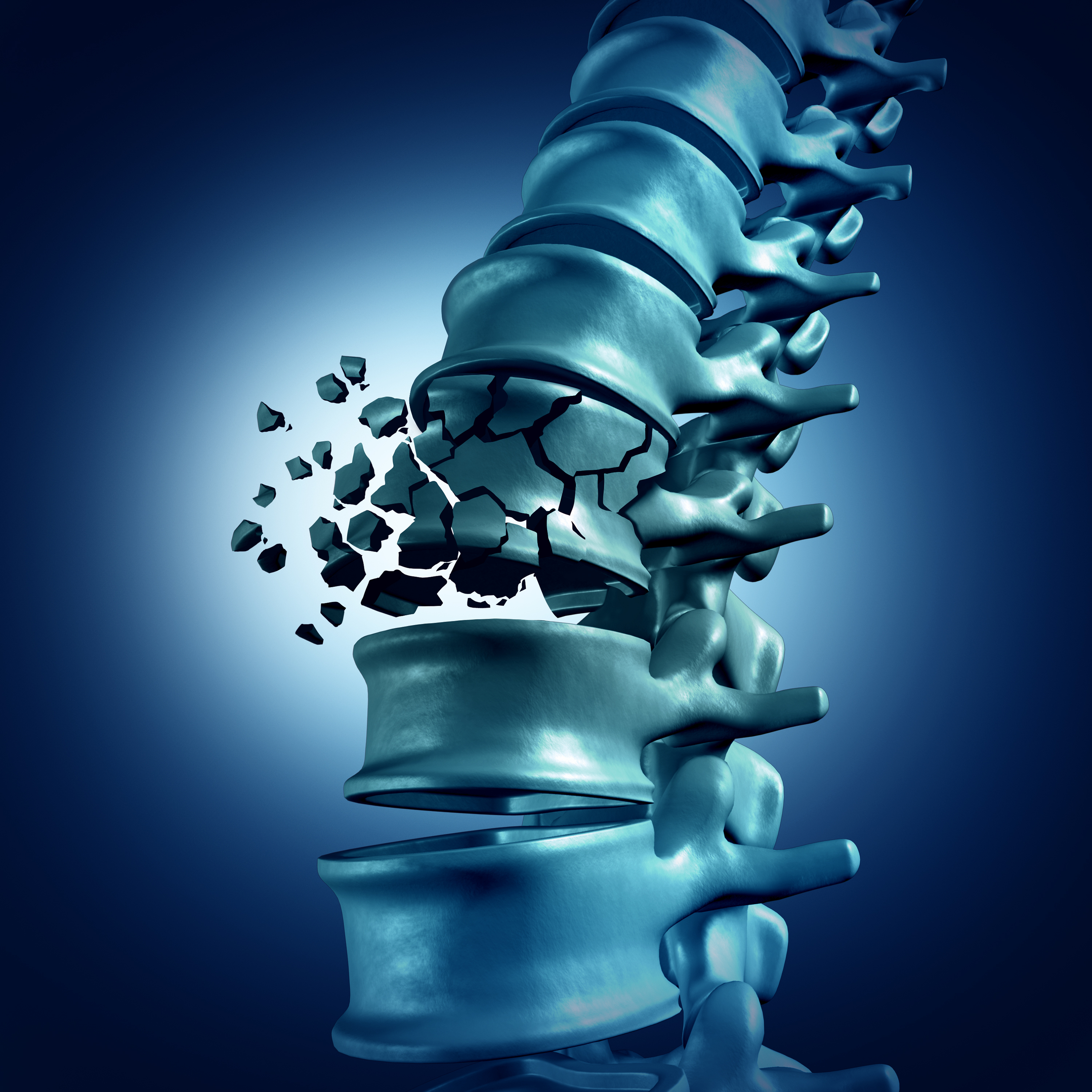 How Serious Is A Spinal Compression Fracture how-serious-is-a-spinal-compression-fracture